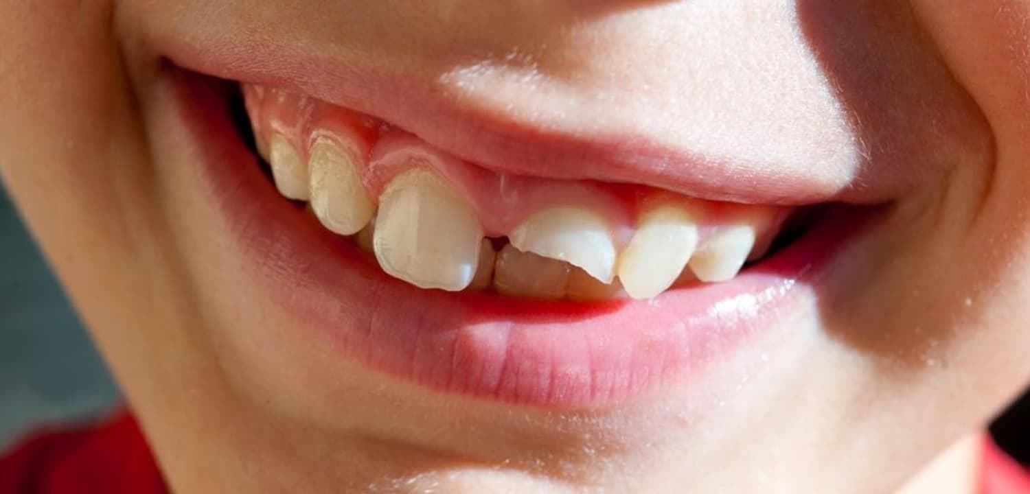 Traumatismos dentales: ¿qué hacer en caso de recibir un golpe en la boca?