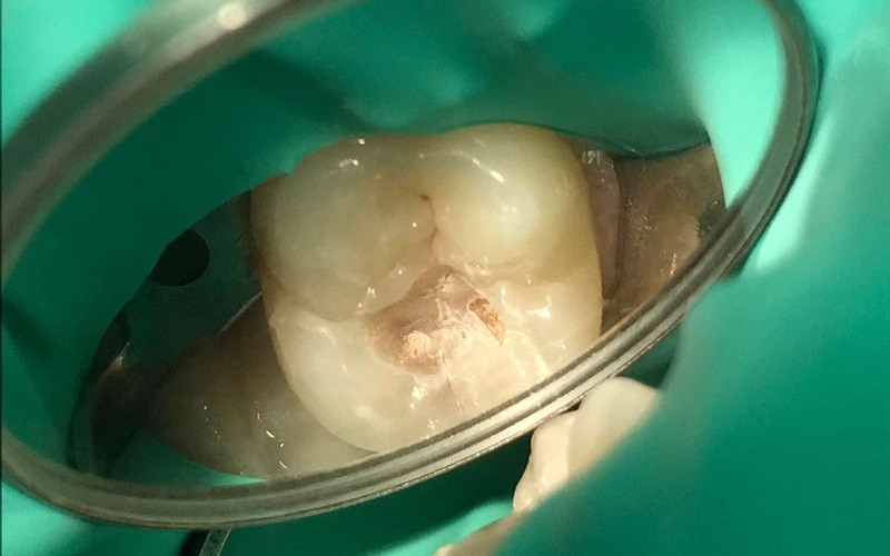 Aislamiento del diente para hacer una endodoncia