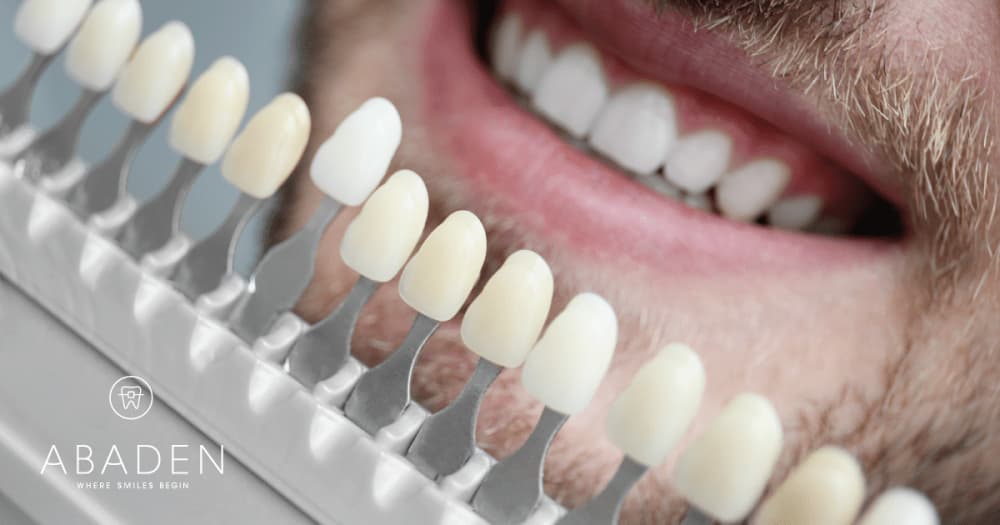 Verdades y mentiras sobre el blanqueamiento dental
