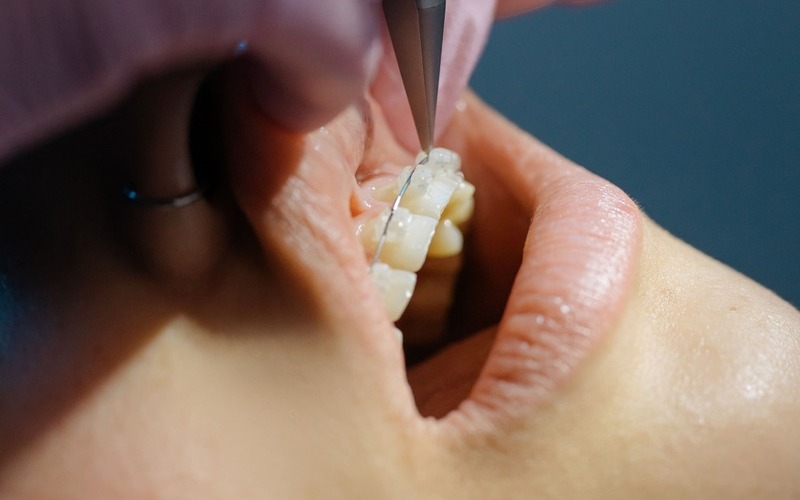 ¿Qué son los brackets de porcelana? ¿Cuáles son sus ventajas?