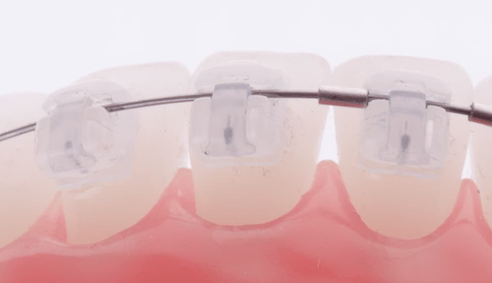 Brackets porcelana: cuándo utilizarlos