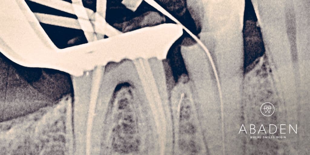 Reendodoncia: ¿qué es y en qué casos está indicada?