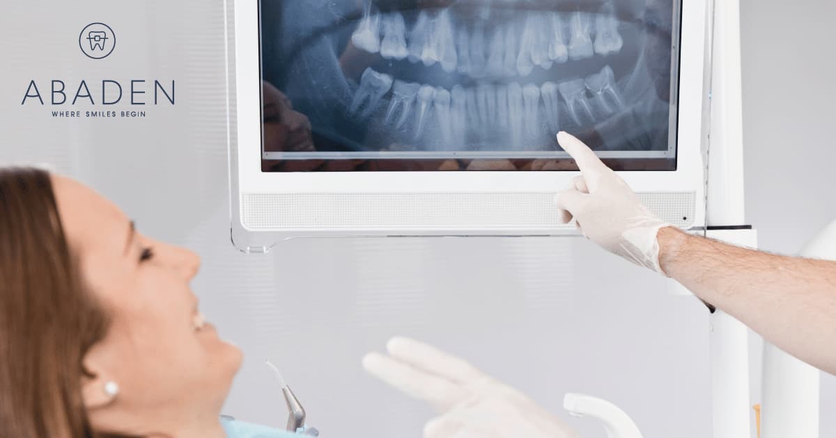 ¿Cuánto duran los implantes dentales? ¿Cómo se puede alargar su vida útil?