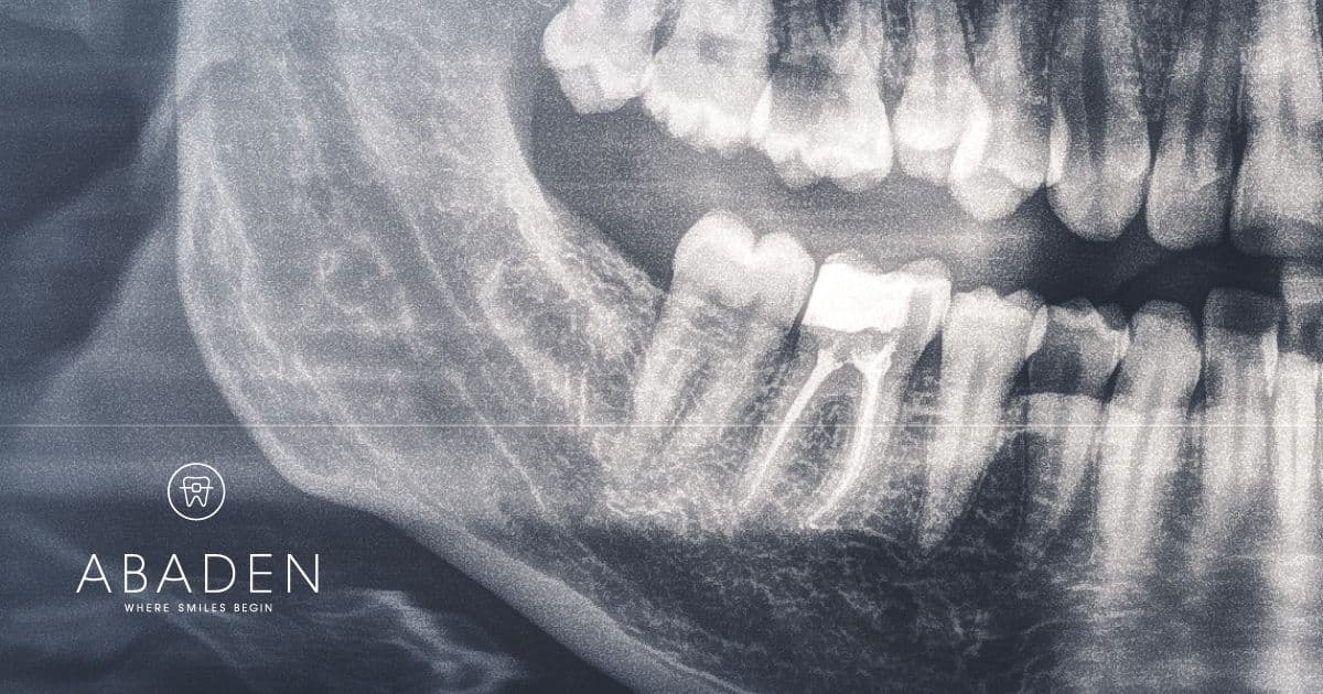 ¿Qué es una endodoncia multirradicular? ¿Cuál es su precio?
