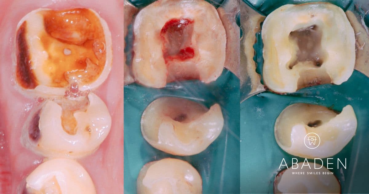 Todo lo que debes saber sobre una endodoncia