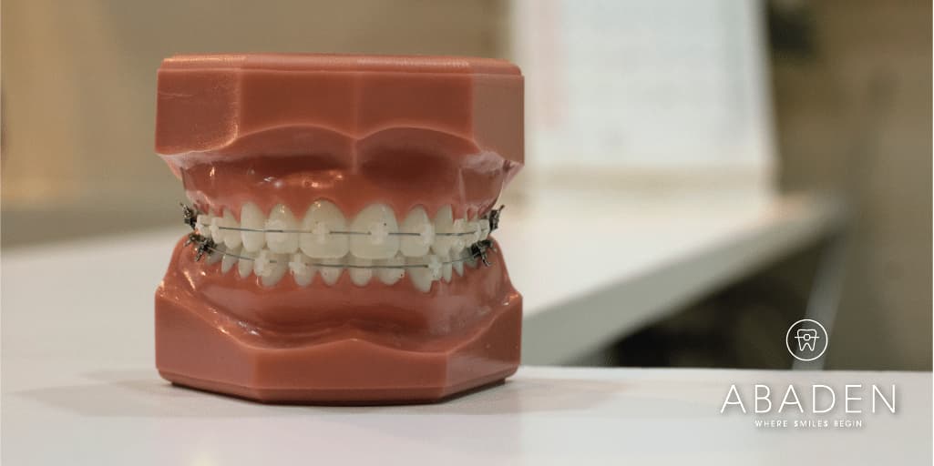 Mitos sobre brackets