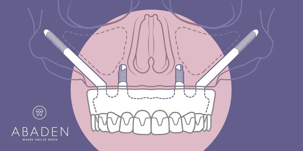 Cómo son los implantes cigomáticos