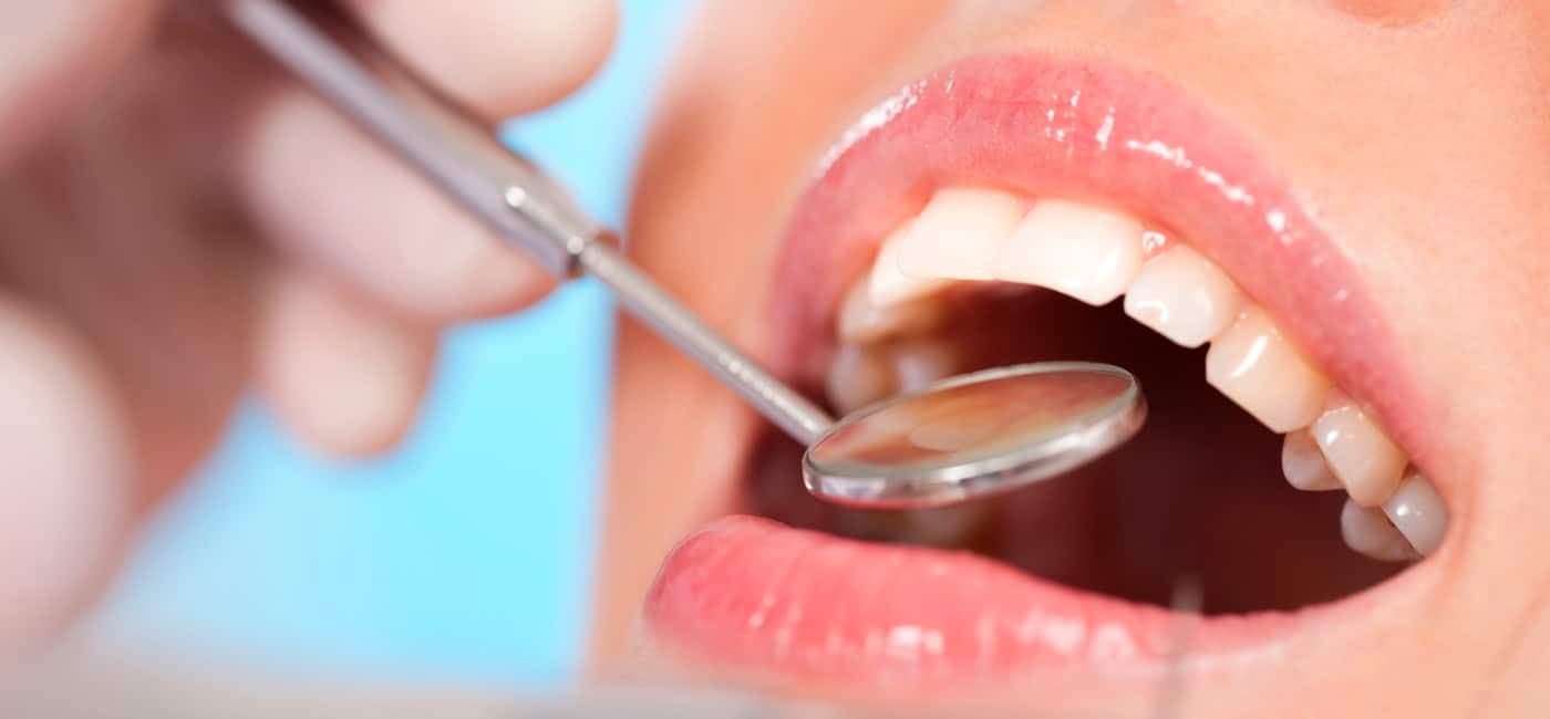¿Qué es una limpieza dental profesional?