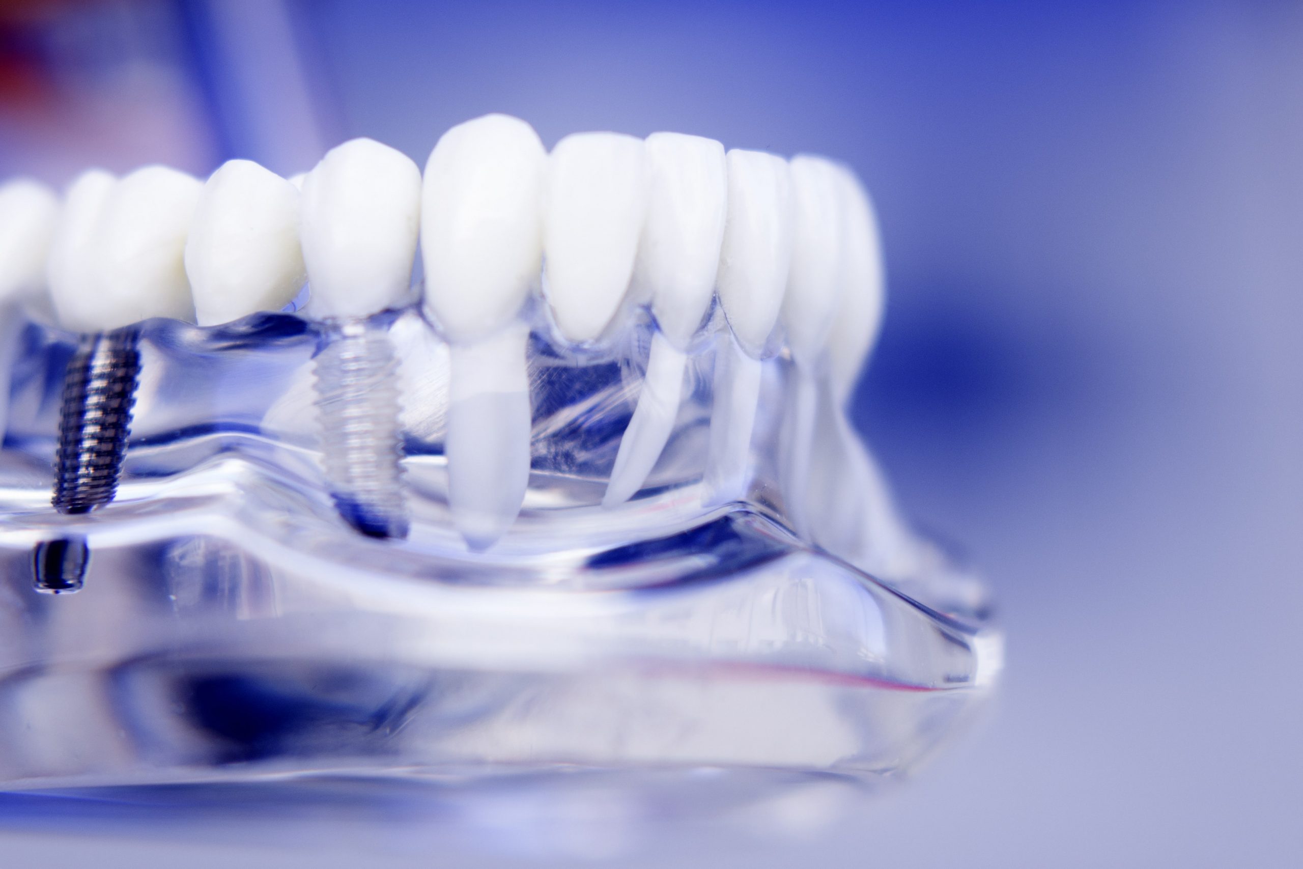 Mitos acerca de los implantes dentales