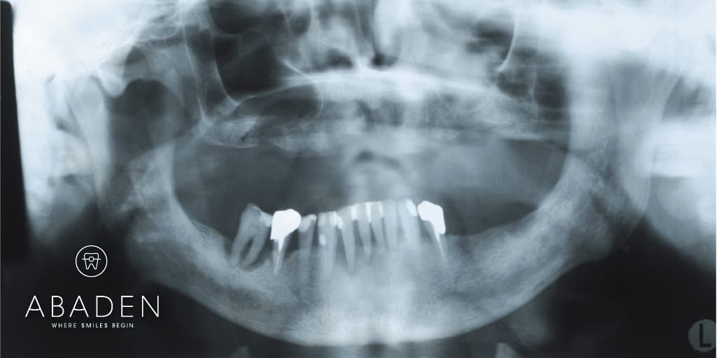 Peligros de la falta de dientes