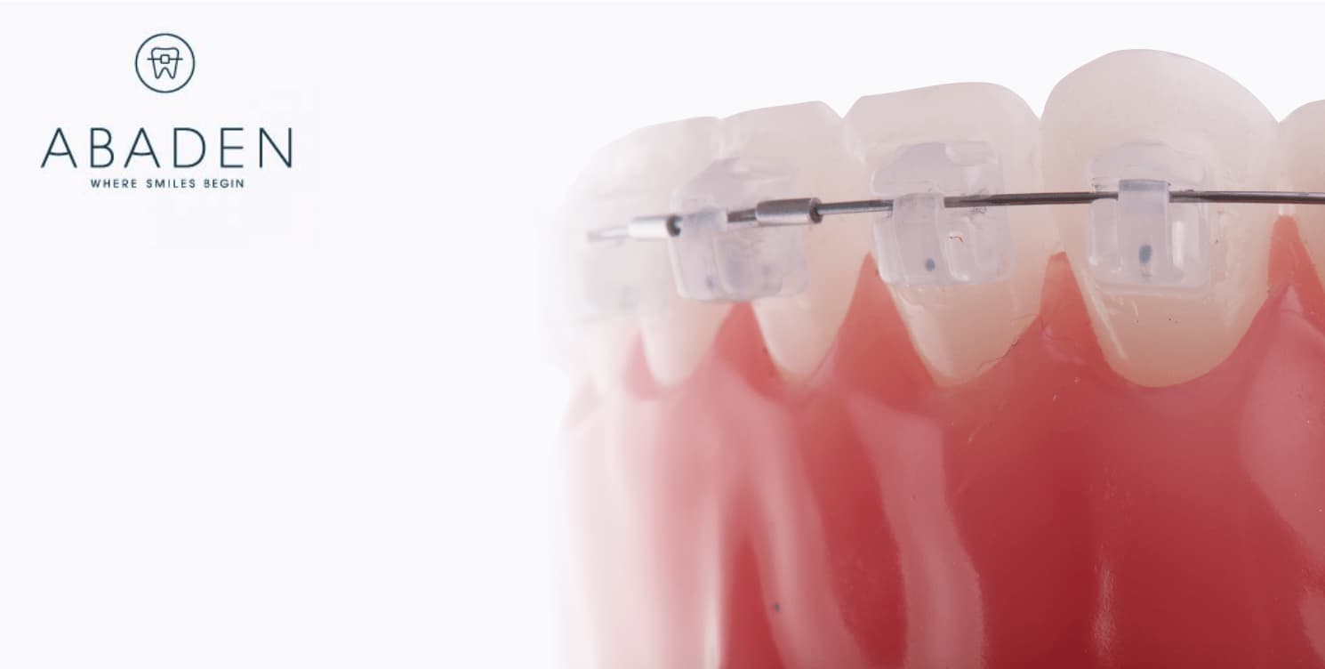 Cuánto cuestan los brackets invisibles
