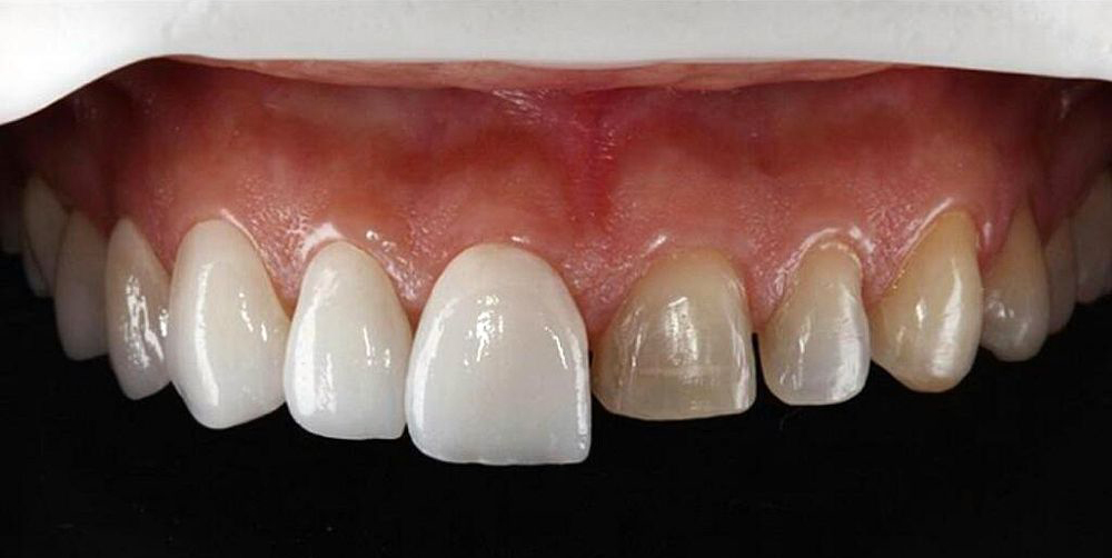Precio carillas dentales 2021 Abaden dentistas