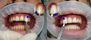 Blanqueamiento Dental