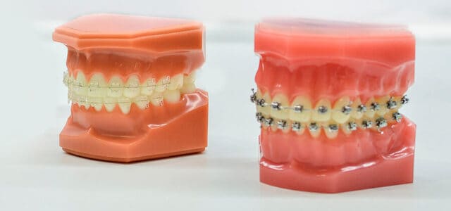 Brackets transparentes