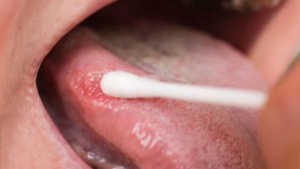 Insustituible Agotamiento Serpiente Remedios caseros para las llagas en la lengua | Abaden