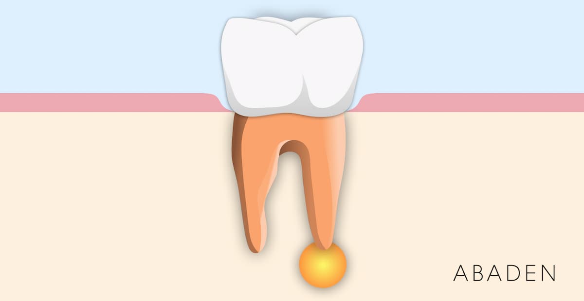 Absceso dental