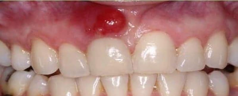 Absceso Periapical Agudo