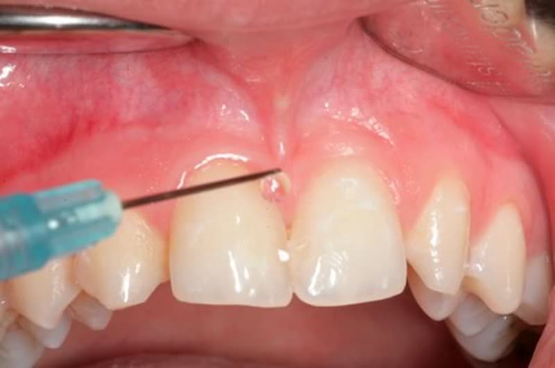 Ácido hialurónico en odontología