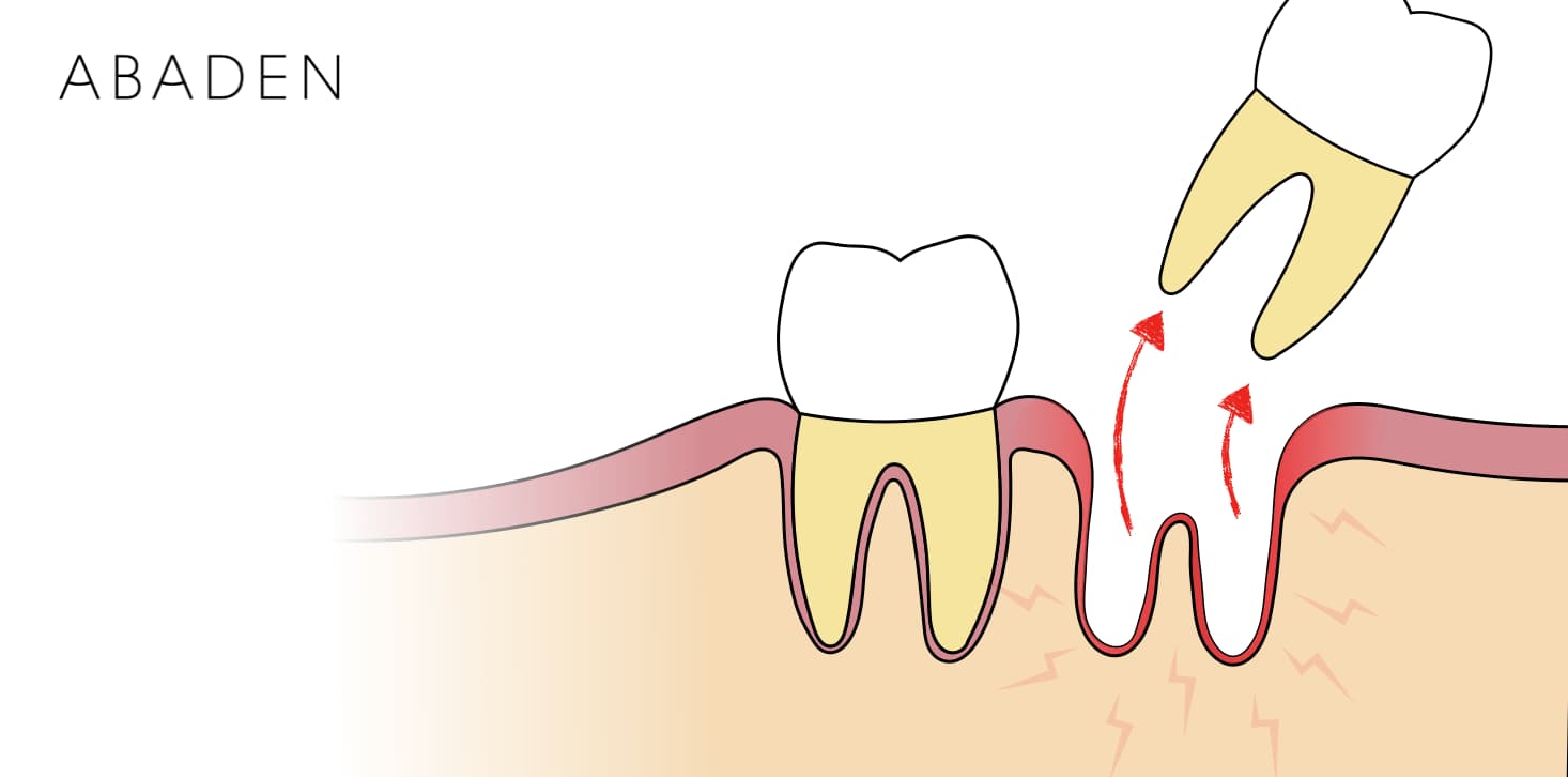 ¿Cómo se cura una alveolitis dental? ¿Cuánto tiempo tarda?