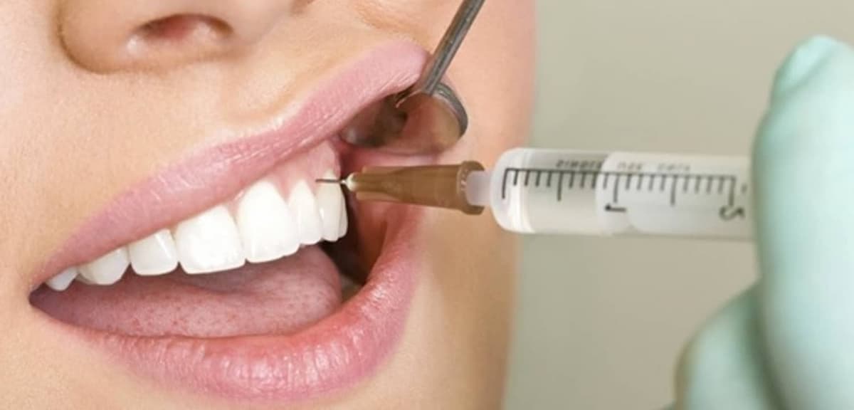 Tipos de anestesia dental. ¿En qué tratamientos se usa?