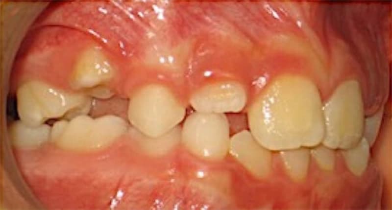 ¿Qué es la anquilosis dental y cuáles son sus causas?