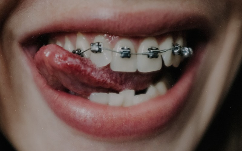 ¿Qué es el apiñamiento dental?