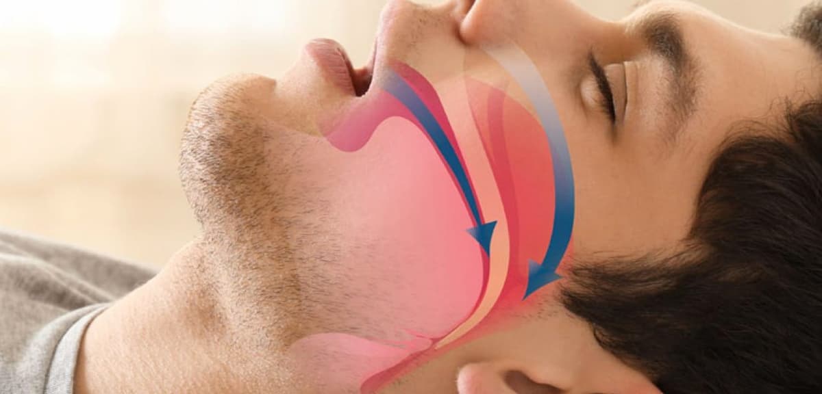 Síntomas de la apnea del sueño: ¿cómo sé si la sufro?