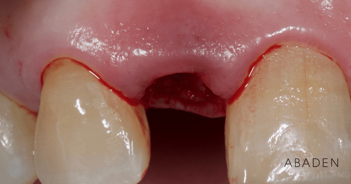 Tratamiento de la avulsión dental