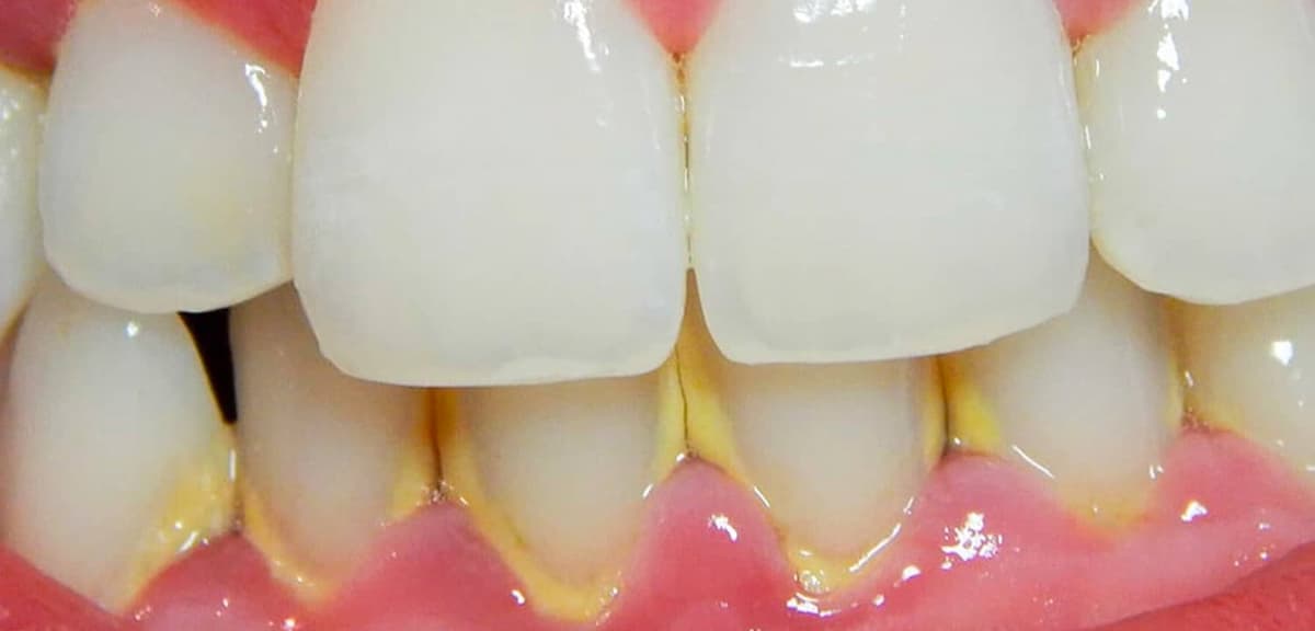 ¿Qué es el biofilm dental y Cómo se forma?