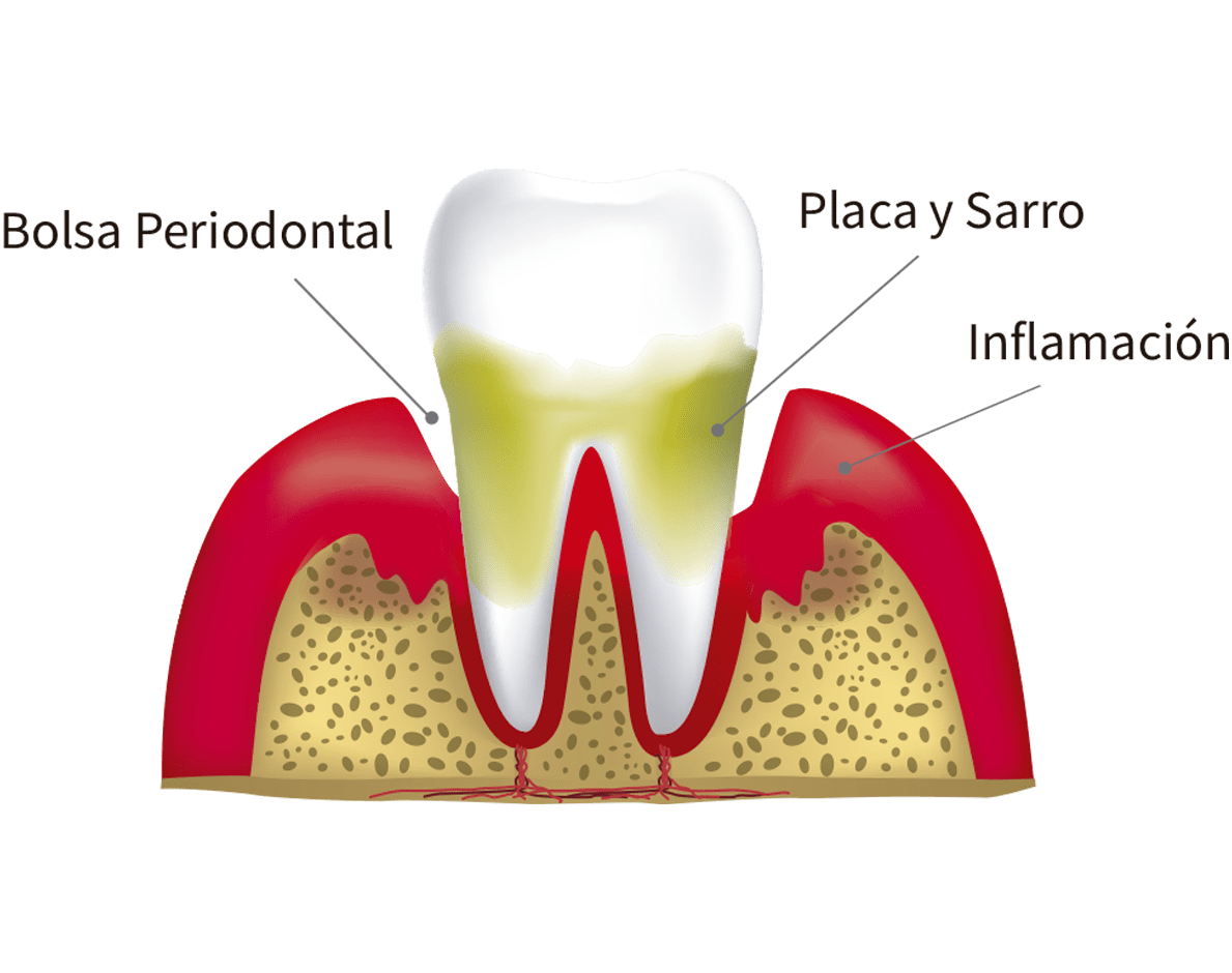 castillo batería superficie Bolsas periodontales: ¿Qué son, cómo se forman y por qué debo preocuparme?  - Abaden dentistas