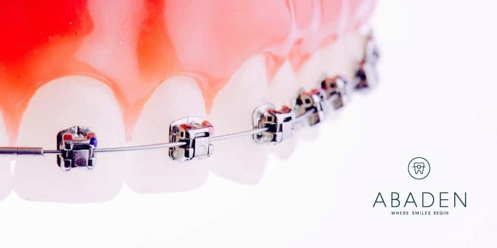 Brackets autoligables: ¿Cómo funcionan? ¿Son mejores que los convencionales?