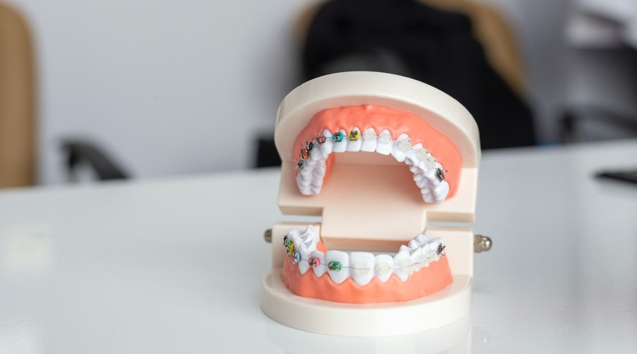 Brackets convencionales con ligaduras de colores