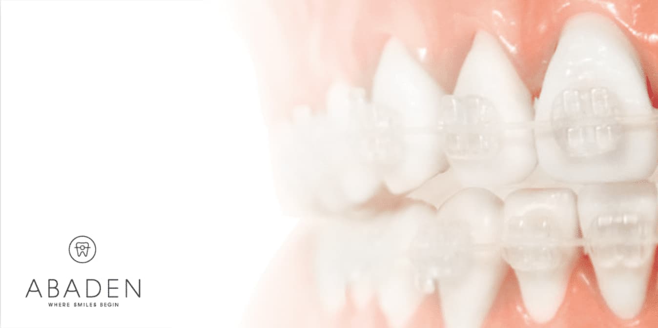 Brackets de zafiro: ¿Qué ventajas tienen y cuánto tiempo hay que llevarlos?