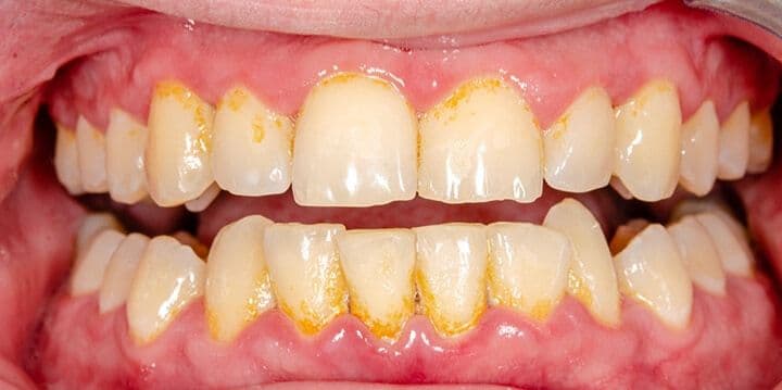 ¿Qué es un cálculo dental?