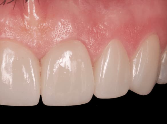 Tallado Carillas – ¿Es necesario tallar el diente para colocar una carilla dental?