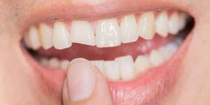 carillas dentales
