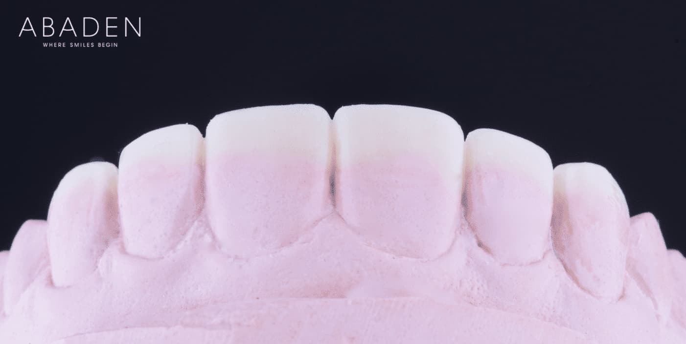 Carillas dentales: ¿Qué ventaja tiene su uso?