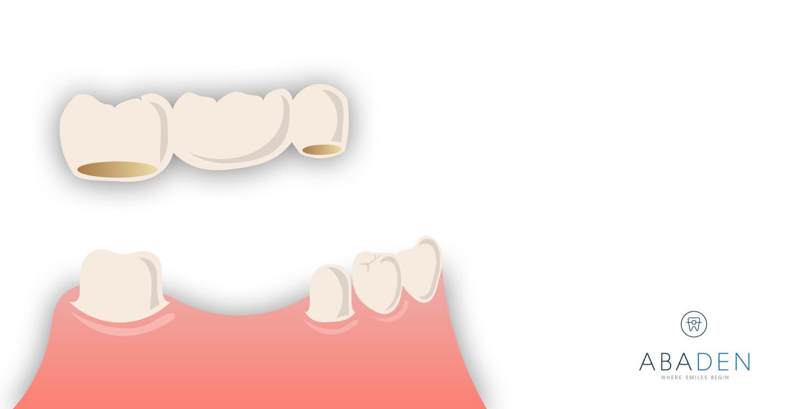 Cómo se lleva a cabo la colocación de un puente dental