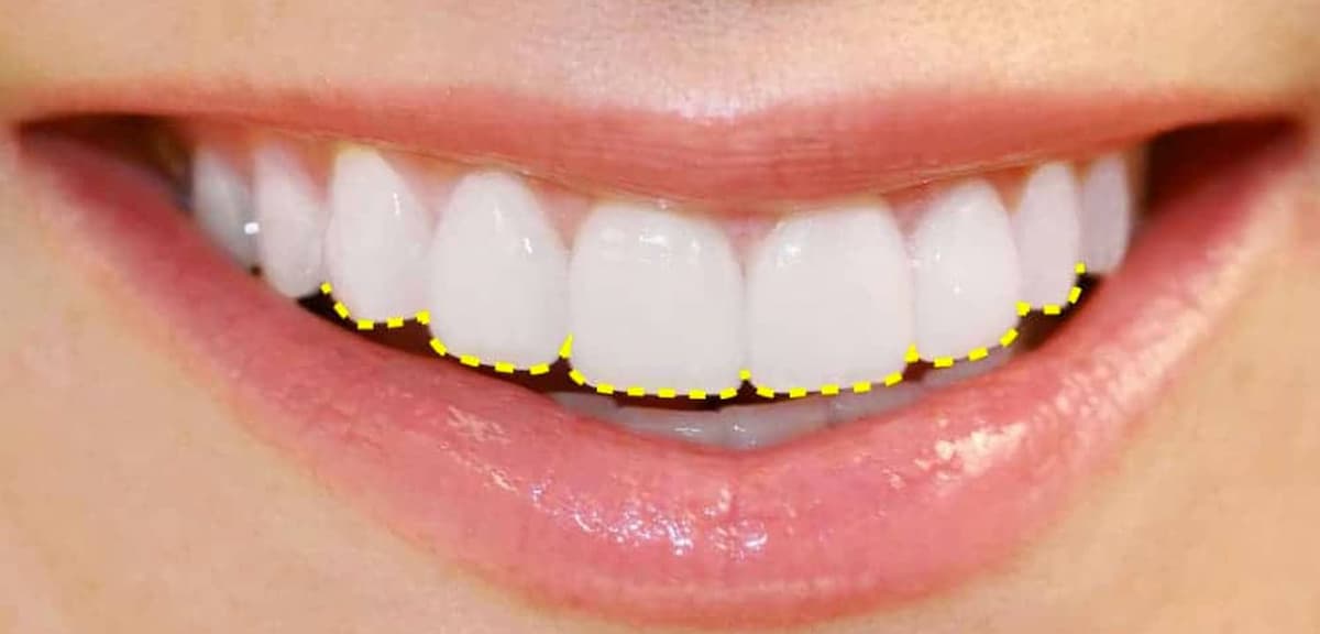 ¿En qué consiste el contorneado dental?
