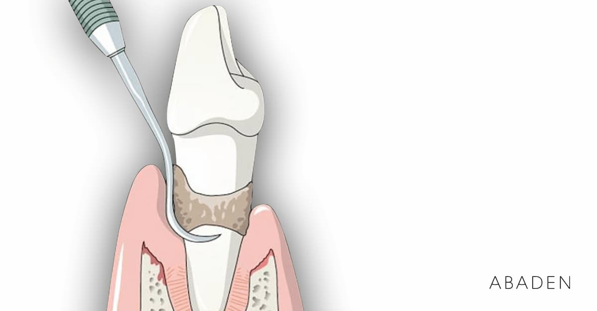 ¿Qué es un curetaje dental y para qué sirve?