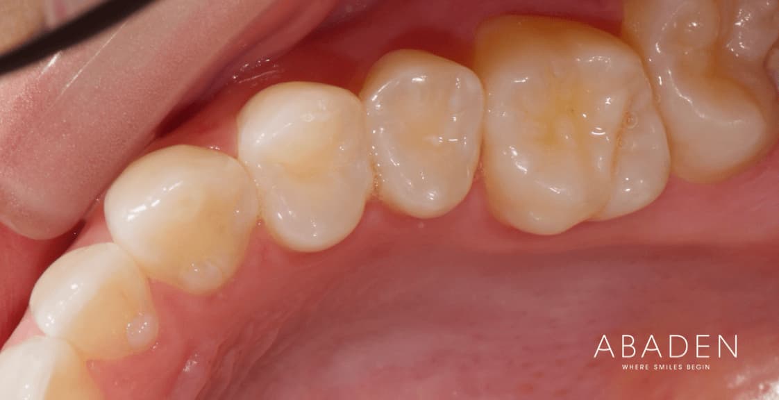 ¿Cuántos dientes tenemos?