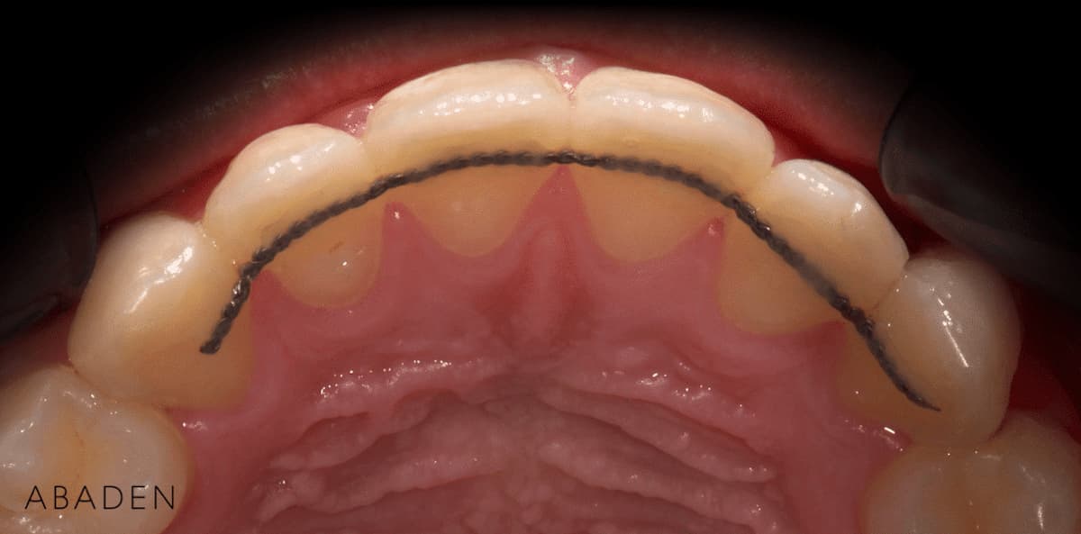 Retenedores dentales: ¿para qué sirven y cuánto tiempo hay que usarlos?