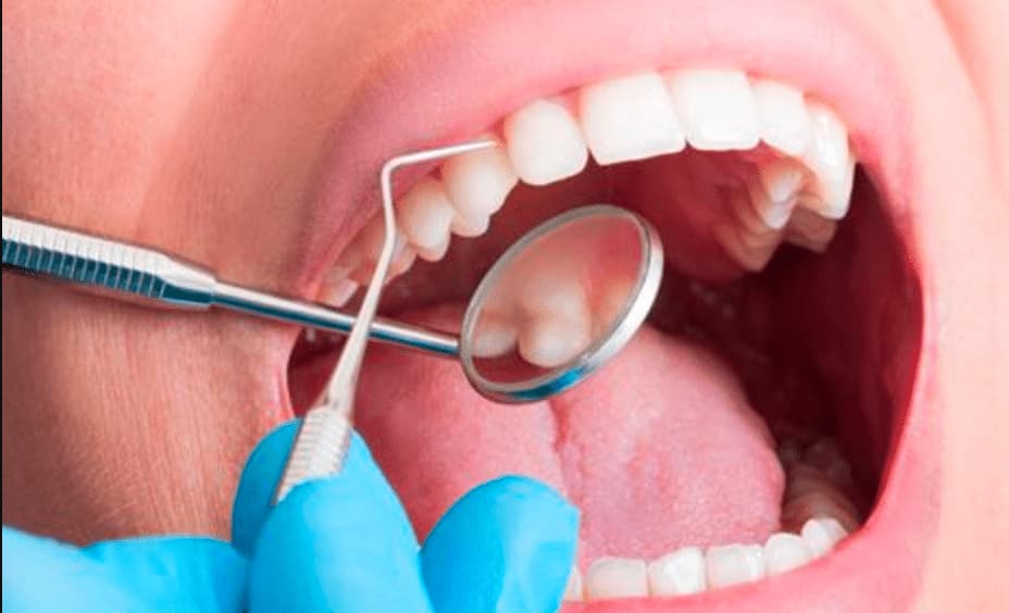 ¿Cuál es el precio del curetaje dental?