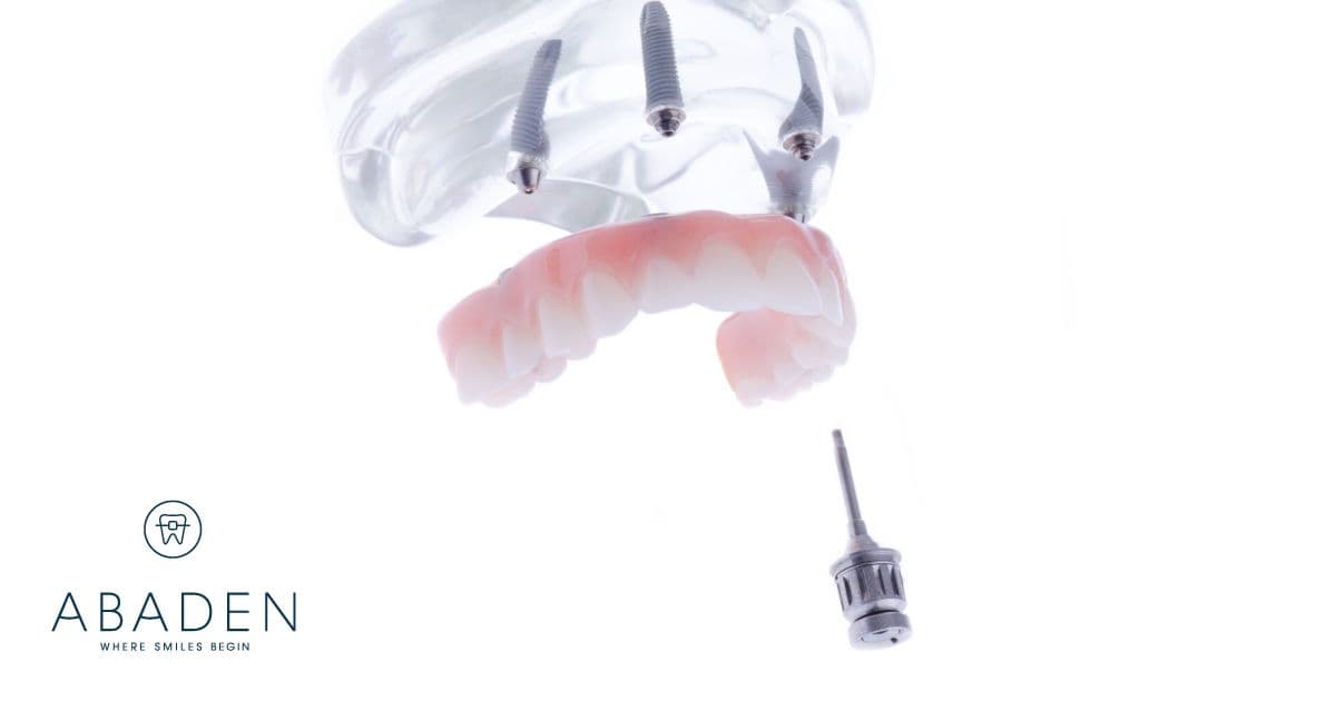 Por qué elegir dentaduras postizas sin paladar