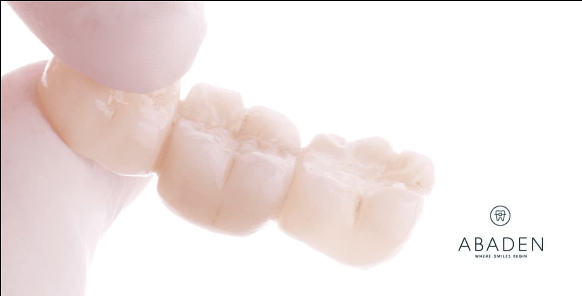 Qué diferencias existen entre las coronas de Zirconio y las de porcelana