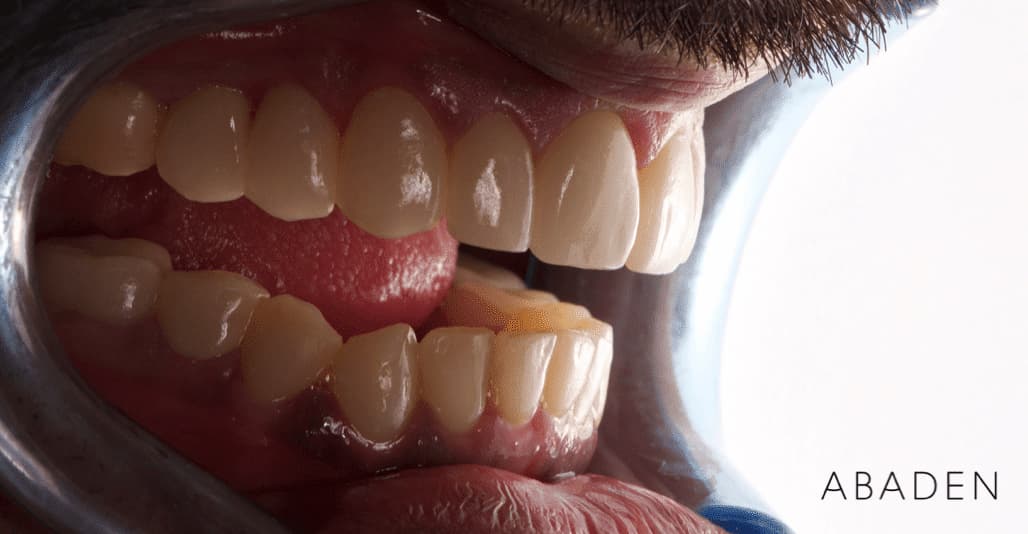 Duración carillas dentales y cuidados necesarios