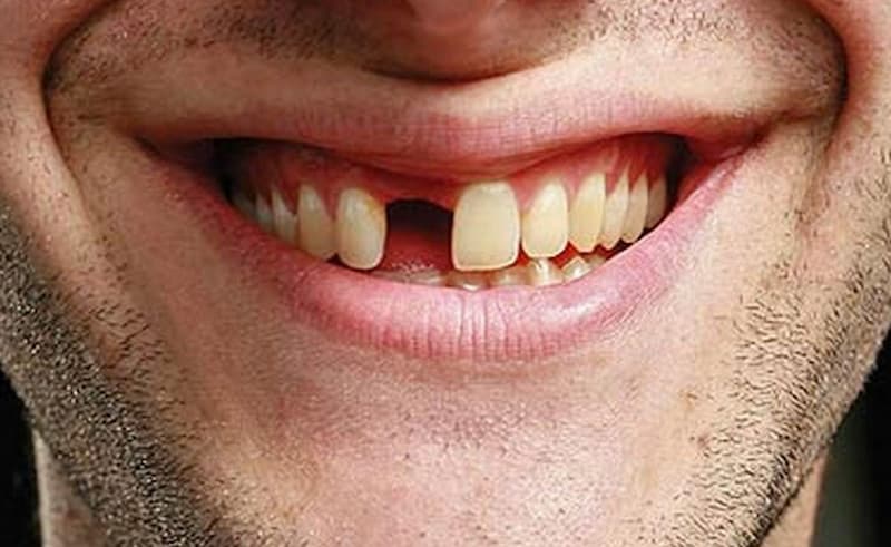 ¿Qué es el edentulismo?¿Cómo solucionarlo?