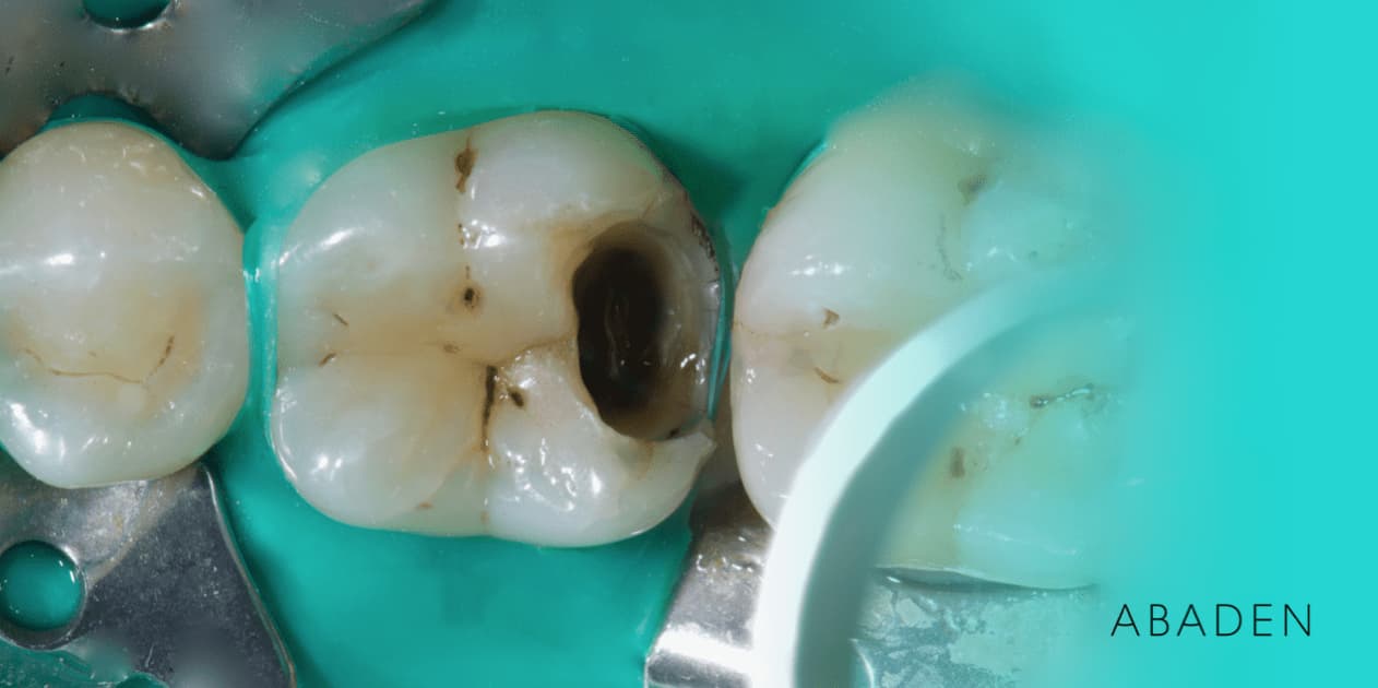 Cómo se hace un empaste dental