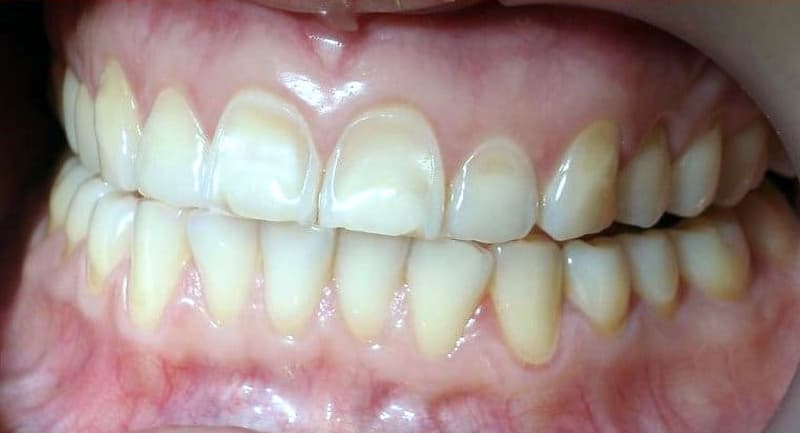Los efectos de la erosión dental en la salud