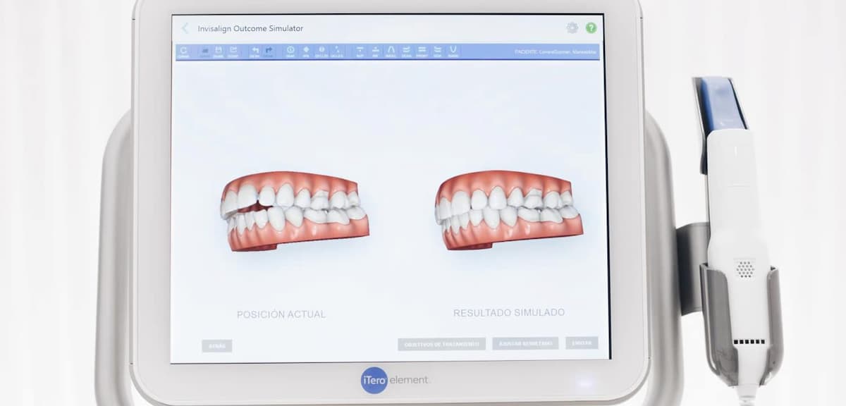 ¿Qué es el escáner intraoral iTero? Su uso en ortodoncia Invisalign